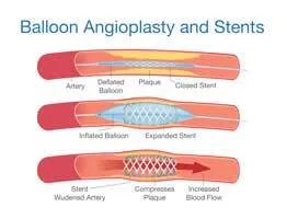 balloon-angioplasty