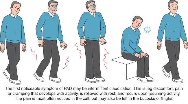 intermittent-claudication-650